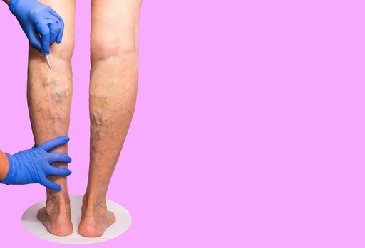 what are the treatment options for varicose veins.